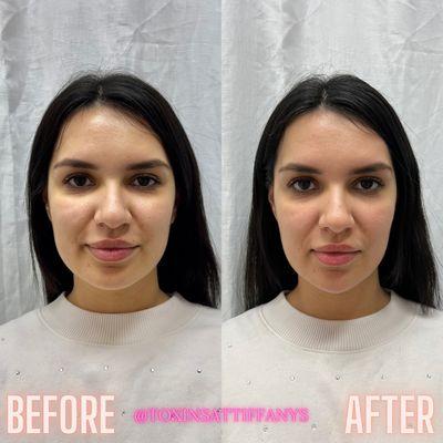 Facial slimming using dermal filler in the chin and jaw