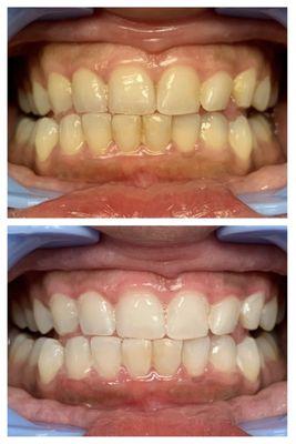 Let us help you brighten your smile!