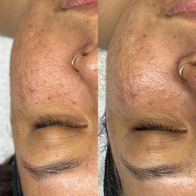 Before & After Acne Facial Treatment