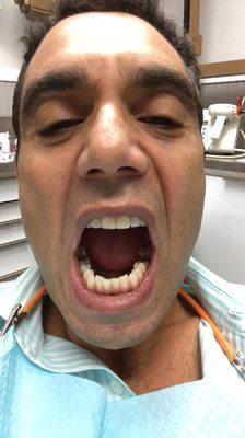 Nobody wants to go to the dentist.  But if you have to.. Dr. Bloch is the best in Miami.