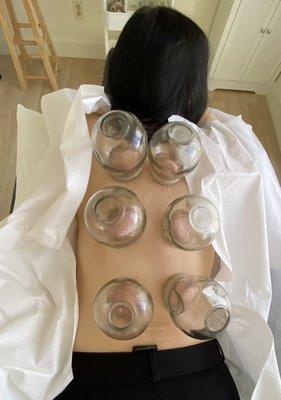 Cupping therapy