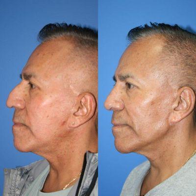 62 year old patient desiring a smaller, more natural nose, shown six months post-rhinoplasty