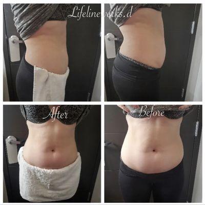 Service performed: Laser lipo, Cavitation, Skin Tightening, and Vacuum Therapy for 30 days.