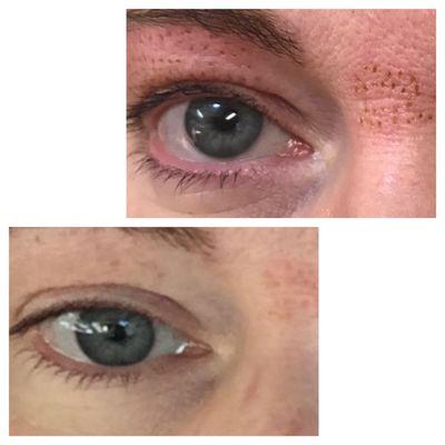 Eyelid done with 1 treatment