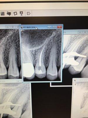 One root canal later...