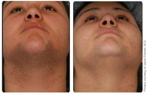 laser hair removal for the chin