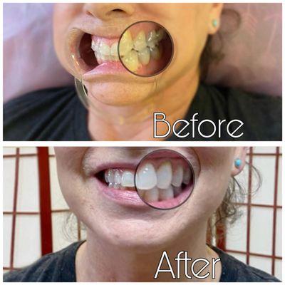 Before and After 1 Laser Teeth Whitening