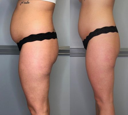 Result after 3 slimming treatments