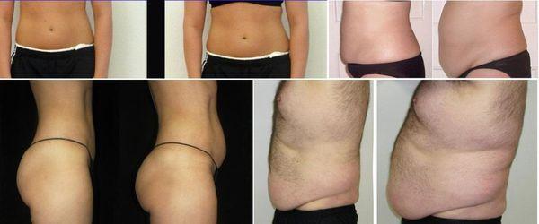 Body sculpting works! LipoLaser, noninvasive, instant results!