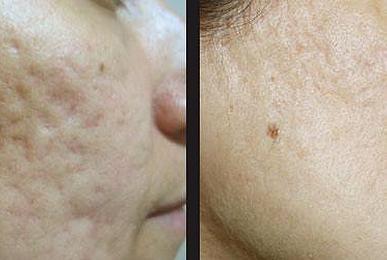 Skin Needling. No downtime, remarkable results.