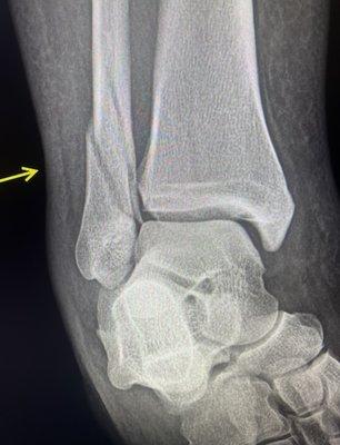 Ankle fracture