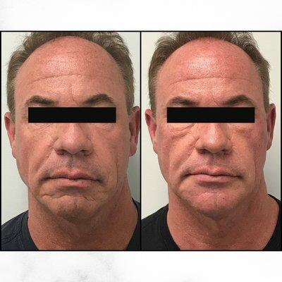 Before and after filler around the mouth and chin and Botox around the eyes, by Dr. Georgine Nanos.