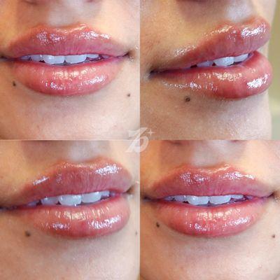 The Mini Lip Plump - lip filler service