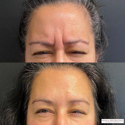 Botox for frown lines