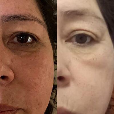 Eye lift and under eye wrinkles reduction