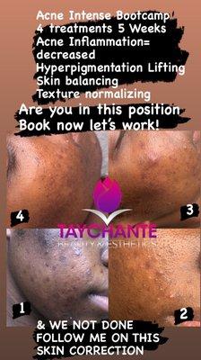 Acne & Hyperpigmentation Treatment