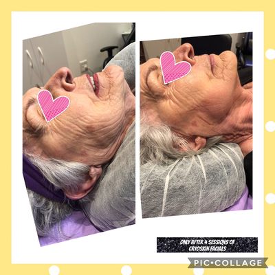 Cryoskin Facial Toning ( Face Lift)