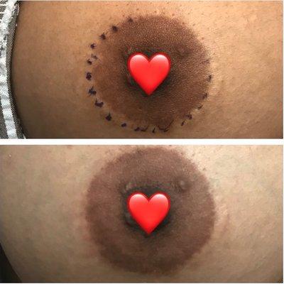 Augmentation of a scar around areola.