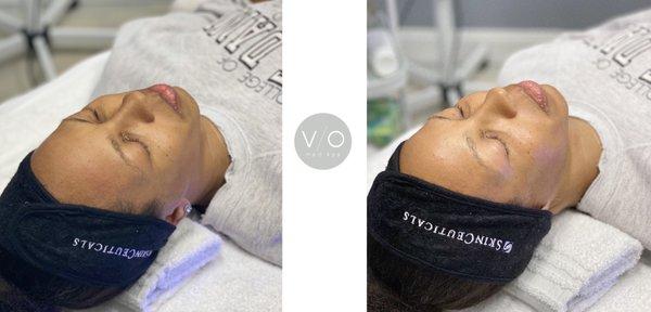 Hydrafacial with Dermaplaning.