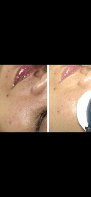 Acne  Facial with amazing  result after first session