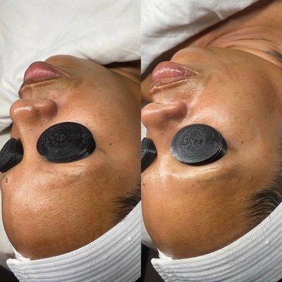 Dermaplaning Facial