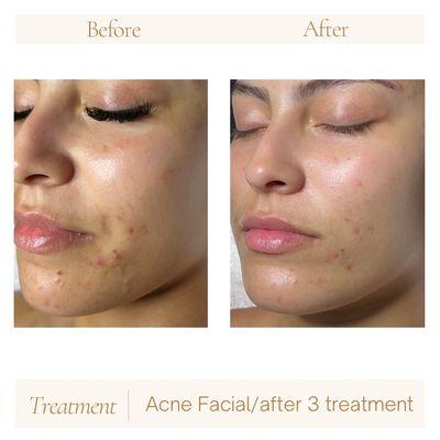 Acne treatments after 3 sessions