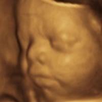 3D ultrasound at 32 weeks