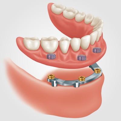 Locator (Stud Retained) Overdentures