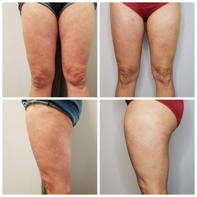 8 treatment BodContour Laser Lipolysis