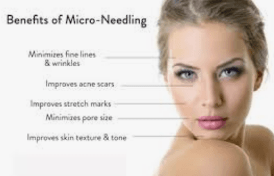 MICRONEEDLING. BUY 3 SESSION GET 4TH FREE WHEN PURCHASED TOGETHER.