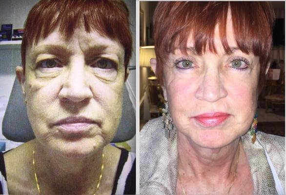 Before and after eyelids and facelift surgery