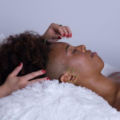 Acupuncture to relieve stress, anxiety and tension