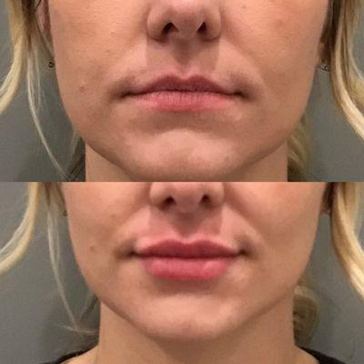 BEFORE+AFTER: Volume build for this beautiful client! Lips injected by our RN Laura!