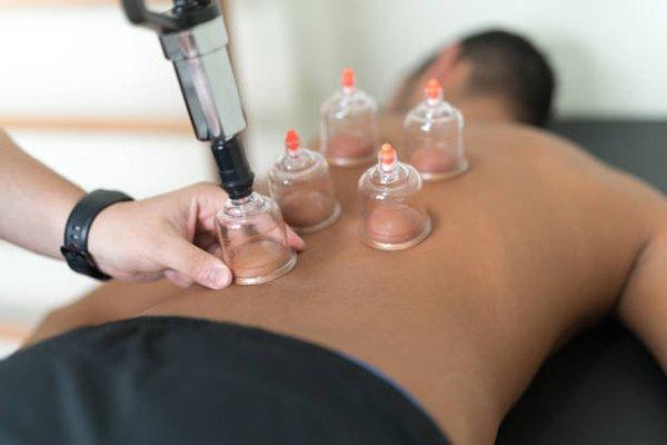 Cupping