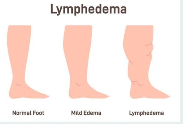 Certified in manual drainage , wound care, and wrapping for all your lymphedema and lymphatic needs.