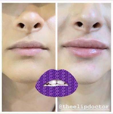 Lip Fillers