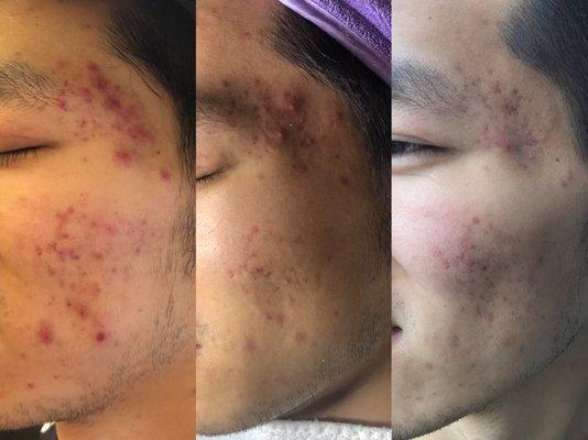 Acne treatments for the 3rd time