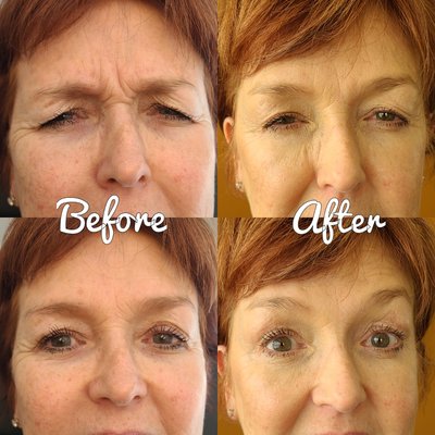 Before & After- Brow Lift, Crow's feet, Frown Lines (11's)