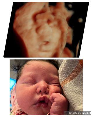 Photo comparison of the same baby. Top is a 5D ultrasound image we captured and bottom is photo of baby after birth!