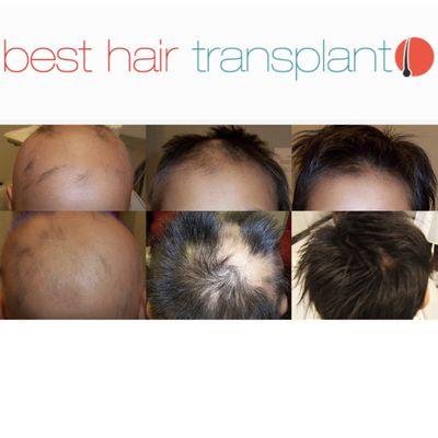 Before and After of a Hair Transplant transformation. Transform your appearance and regain your confidence today!