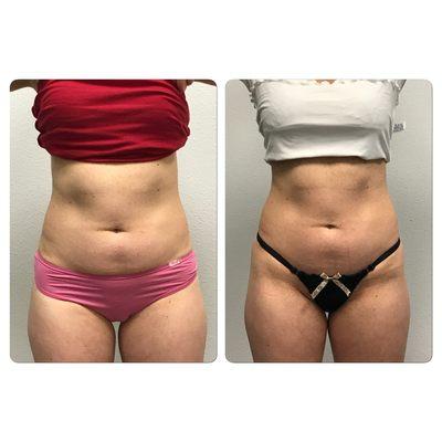 Before & After : Just one month after first Lipo Freeze session