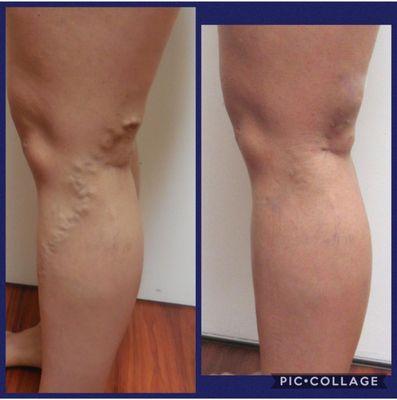 Before and after picture of patients legs with varicose veins and treated with the use of varithena.