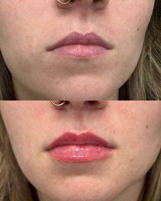 Lip Filler