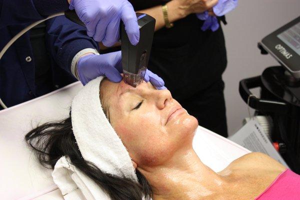 Morpheus8 treatment