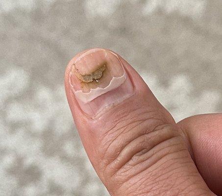 The damage to the nail. It had cracked and hoping it doesn't die.