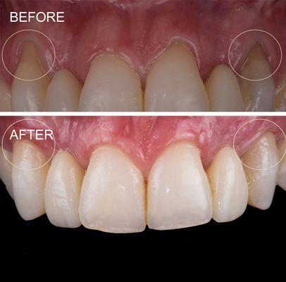 Gingival recession treated with grafting achieving full root coverage.