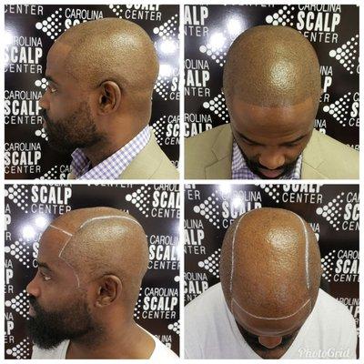 Carolina Scalp Center can give you a clean cut look that will last for years with Scalp Micropigmentation!