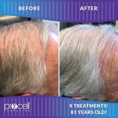 Procell Therapy for Hair Growth