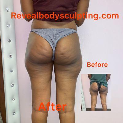 Reveal Body Sculpting