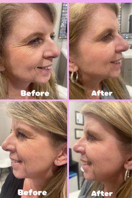 Botox cosmetic will erase unwanted lines in less that 2 weeks!